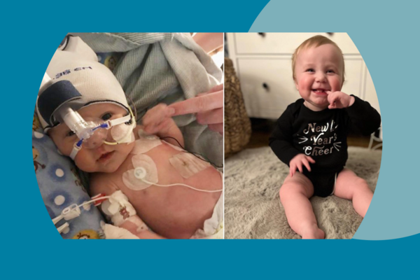 Picture of newborn baby post-surgery net to picture of smiling 1-year-old