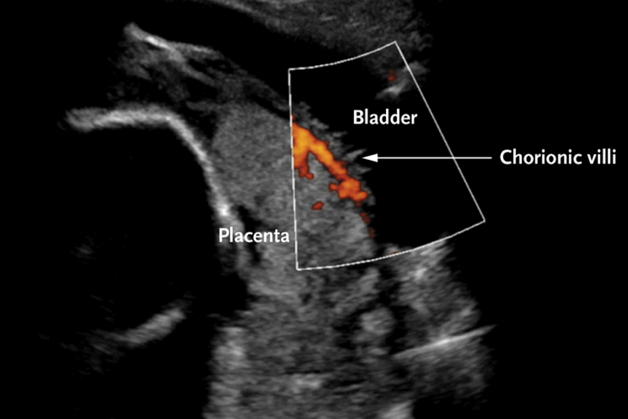 Ultrasound image