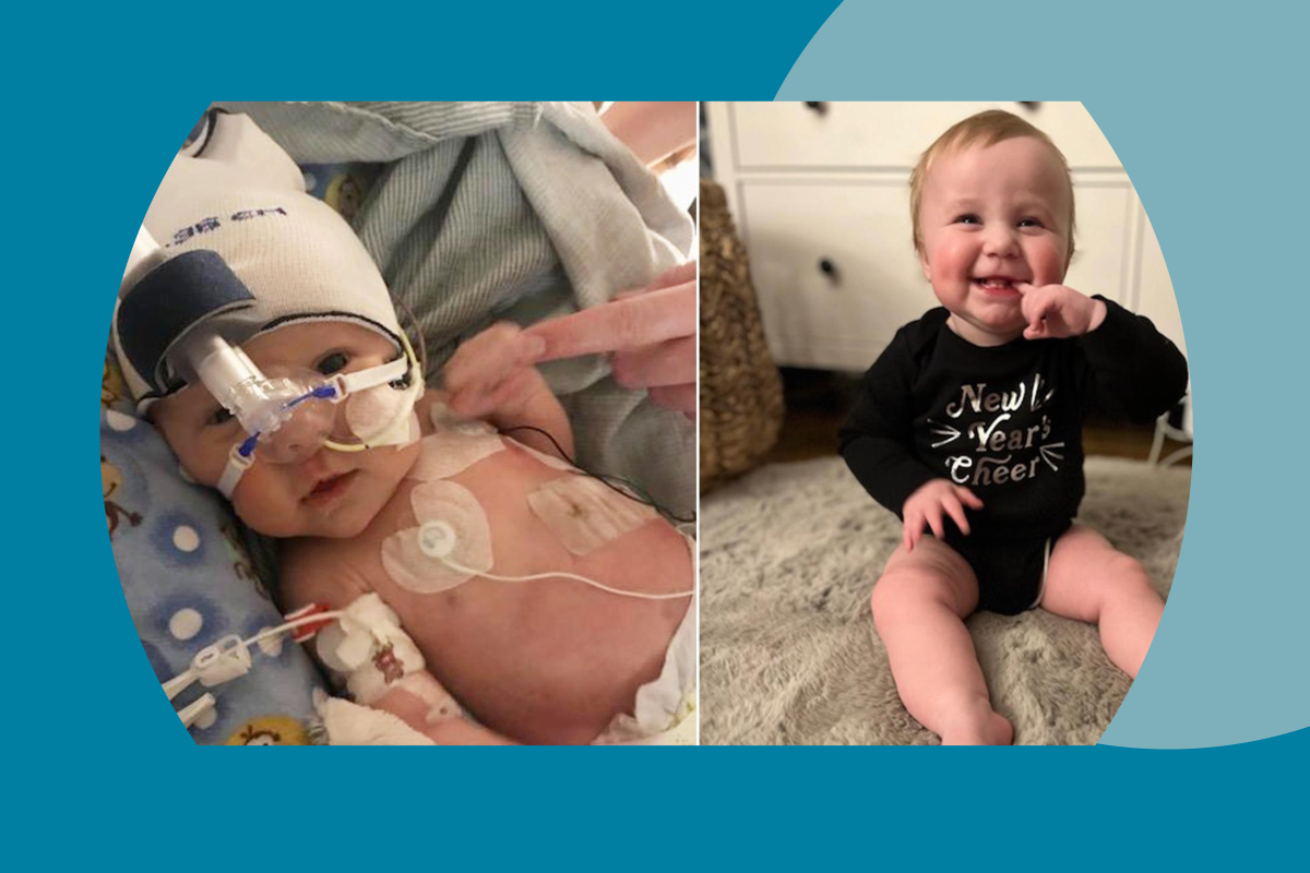Picture of newborn baby post-surgery net to picture of smiling 1-year-old