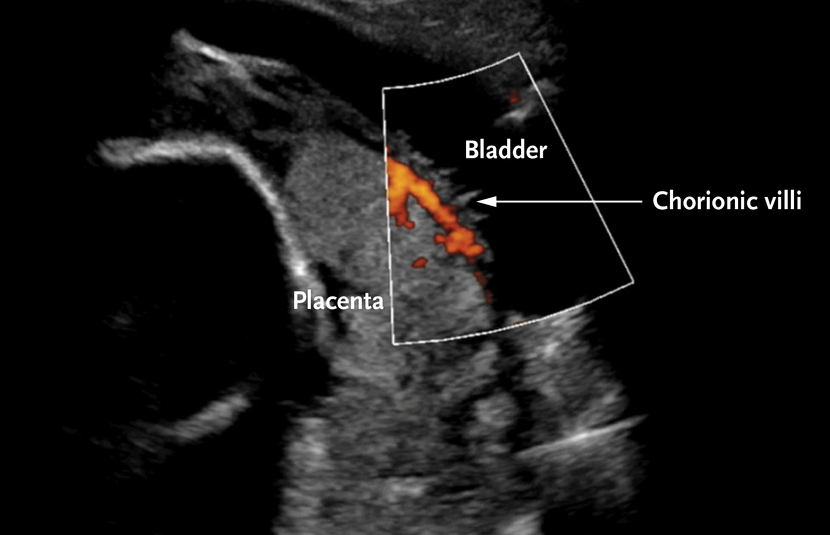 Ultrasound image